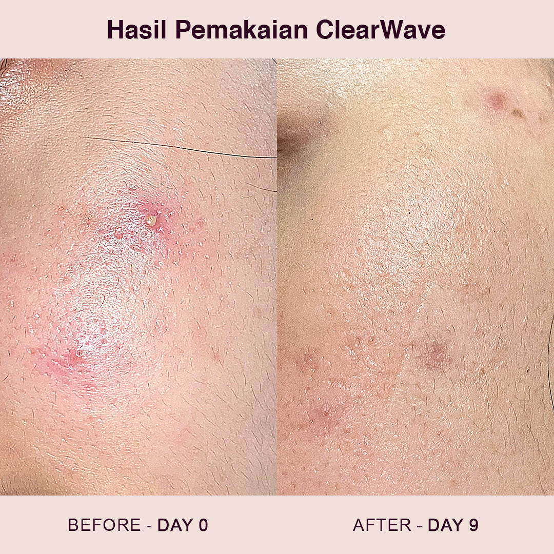 Clearwave Perawatan Jerawat 3 Menit | Acne Pimple Spot Treatment