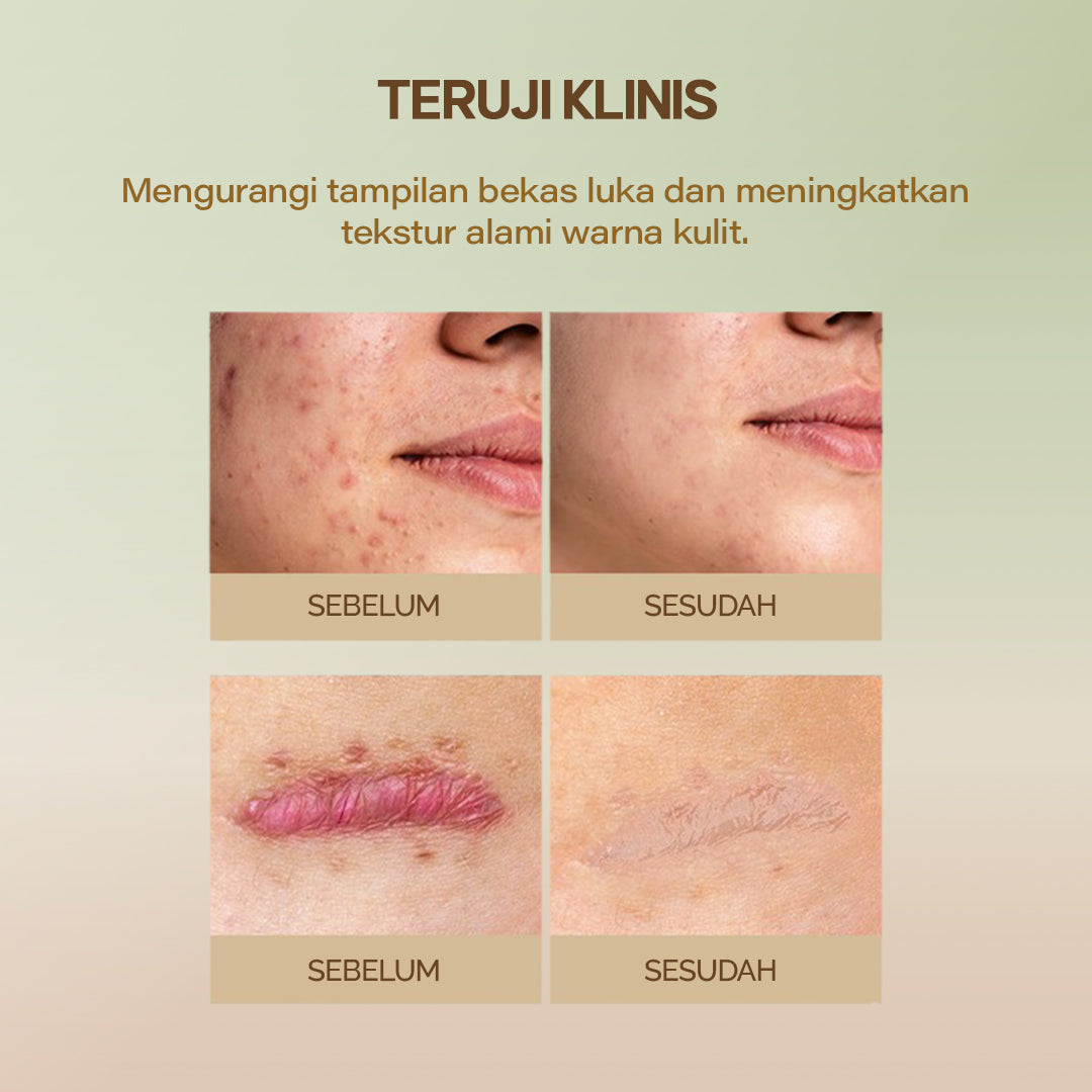 4PCS Scar Sheet - Perawatan Keloid , Bekas Luka - Hodaf by TheSplendor